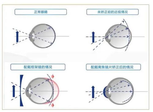 成长宝效果如何？成长宝镜片真的能控制近视度数吗？